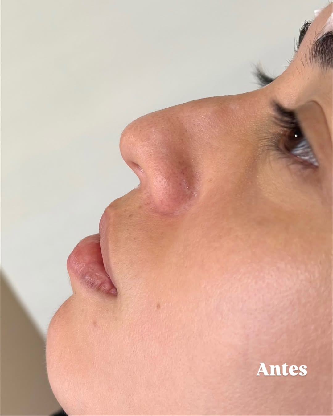 Rinomodelação — Antes