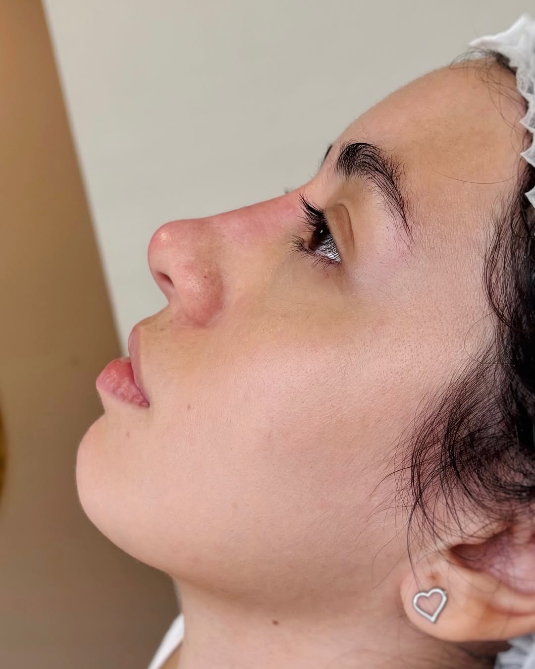 Rinomodelação — Depois